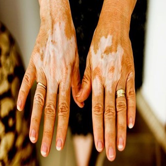 Phương pháp chữa trị Bệnh Bạch Biến Vitiligo và lưu ý trong chế độ ăn